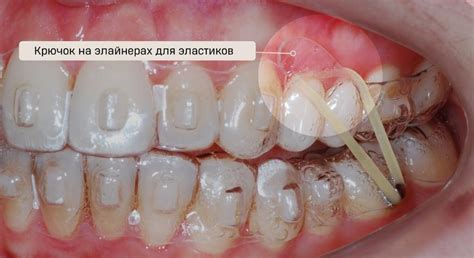 Полезные советы для еды с эластиками на брекетах