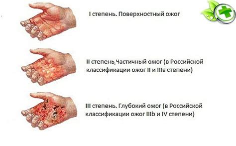 Полезные советы для предотвращения ожогов