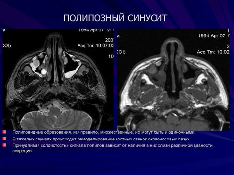 Полипы, инфекции и синусит