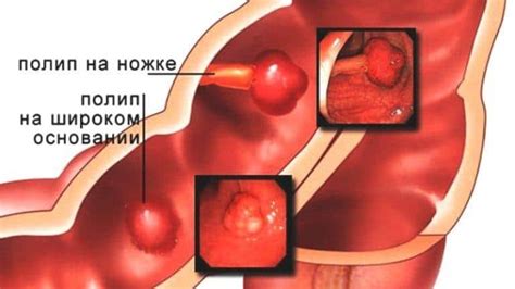 Полипы в прямой кишке: все, что нужно знать