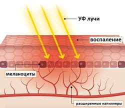 Понятие солнечного ожога и его причины