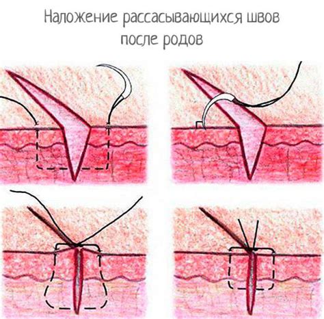 Популярные методы удаления фартука после кесарева секции