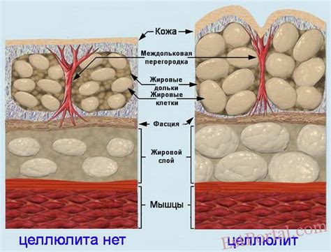 Популярные мифы и заблуждения о целлюлите