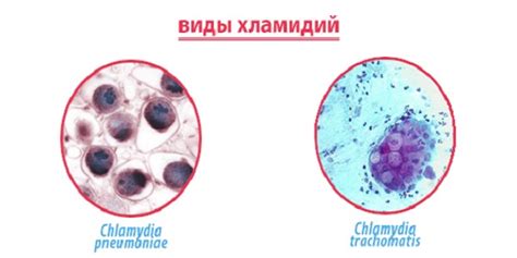 Популярные симптомы хламидий в горле