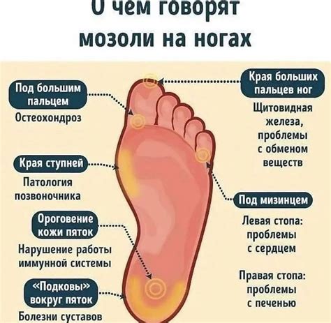 Популярные способы удаления сухой мозоли на ноге