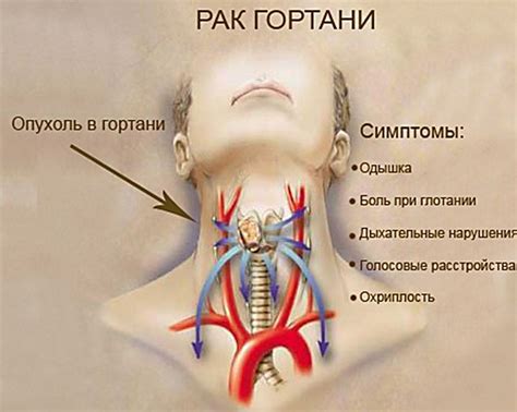 Поражение гортани: причины и симптомы