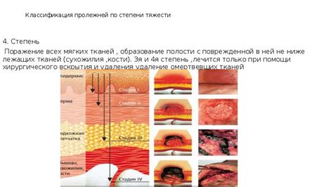 Поражение пролежней