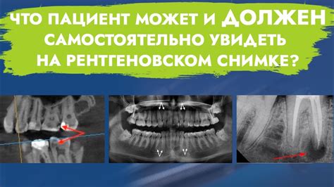 Посетите врача и проведите рентгеновское исследование для точного измерения