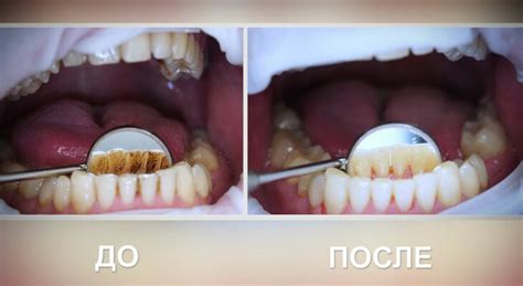 Посещение стоматолога для профессиональной чистки