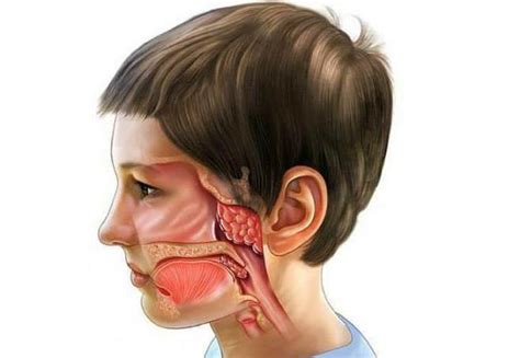 Последствия возобновления роста аденоидов после операции.