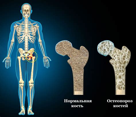 Последствия дефицита кальция