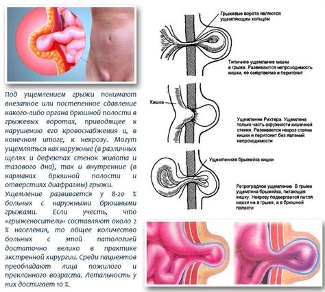 Последствия невыявленной и недолеченной грыжи на животе после кесарева