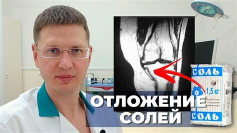 Последствия отложения солей в суставах