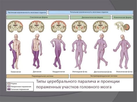 Последствия паралича ног