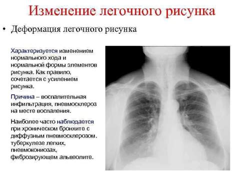 Последствия патологий легочного рисунка