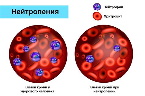 Последствия повышенного уровня нейтрофилов