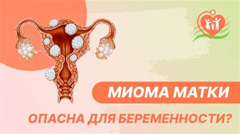 Последствия прогрессирования миомы для организма