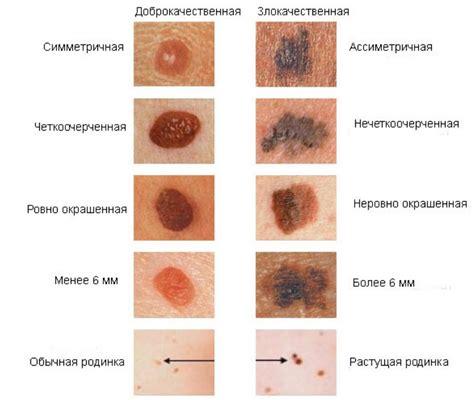 Последствия рака кожи