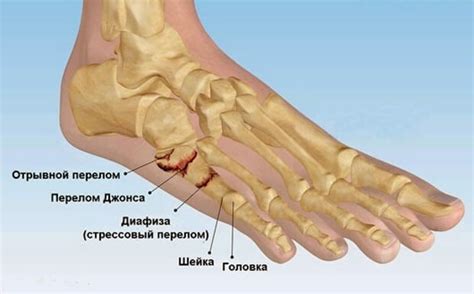 Последствия сломанной кости мизинца ноги