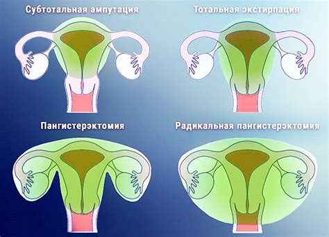 Последствия сохранения матки