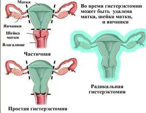 Последствия удаления матки без яичников и какие альтернативы существуют