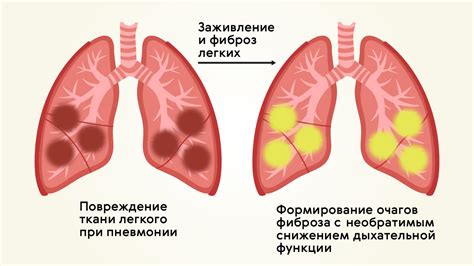 После пневмонии