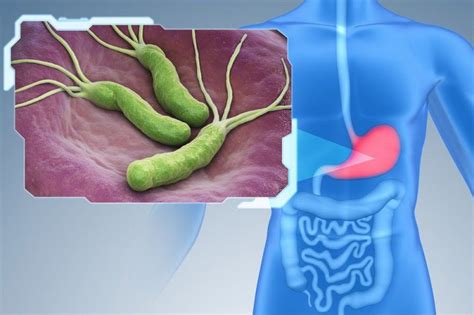 Постоянная тошнота: каковы причины и роль Helicobacter pylori?