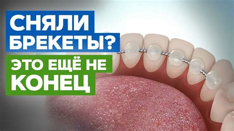 Постоянное ношение ретейнеров