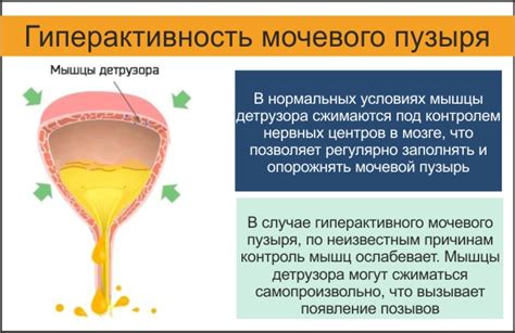 Потенциальные последствия от использования пессария на мочевой пузырь