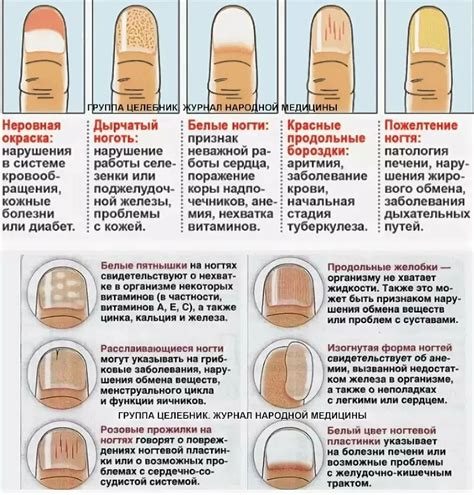 Потеря здоровья ногтей и ногтевых лунок