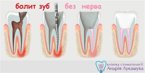 Почему болит зуб при удалении геля лака аппаратом?