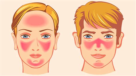 Почему возникает покраснение кожи на лице без повышения температуры