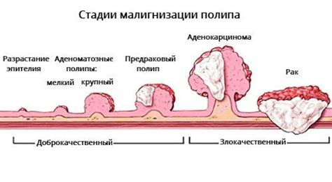 Почему возникают полипы в организме человека?