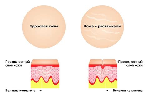 Почему возникают растяжки на бицепсе