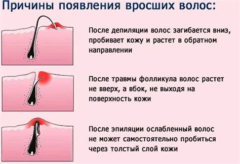 Почему вросшие волосы часто возникают при бритье ног выше колена