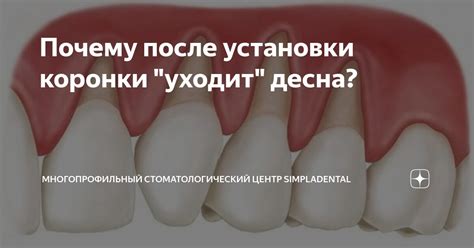 Почему нельзя есть после установки коронки