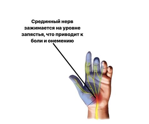 Почему онемевают руки во время сна?