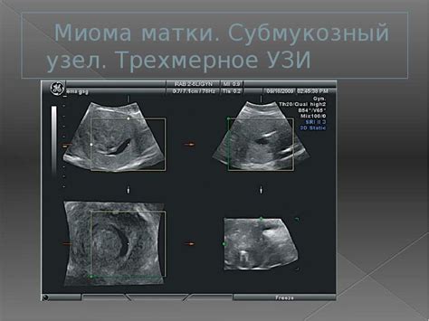 Почему появляется миома в матке?