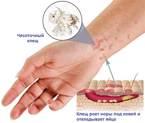 Почему появляется чесотка при нервозности?