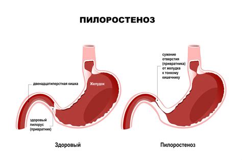 Почему происходит рвота у человека?