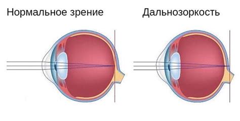 Почему снижается качество зрения - причины и способы исправления