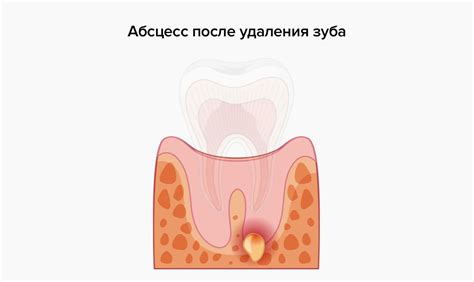 Почему чешется щека при флюсе?