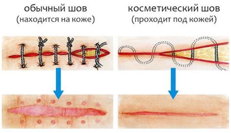 Почему шов мокнет после снятия