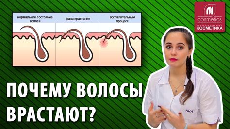 Появление вросших волос после шугаринга