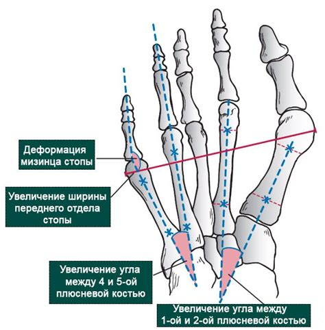 Появление пятого оперона стопы