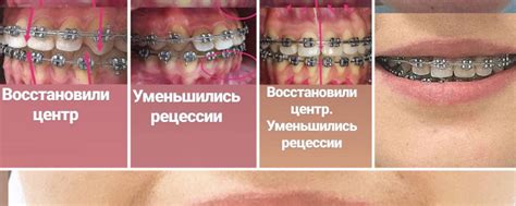 Правила ношения брекетов: основные рекомендации