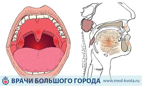 Предостережения перед подрезкой голосовых связок