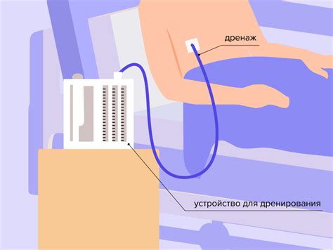 Предосторожности при удалении дренажа после операции на легком