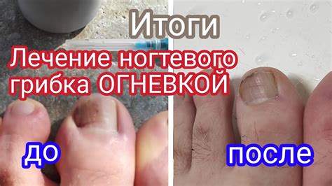 Предотвращение ногтевого грибка