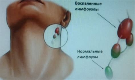 Предупреждение и профилактика лимфаденита при ветрянке